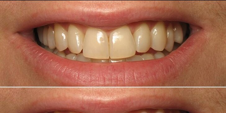 Zářivý úsměv: bezperoxidové bělení zubů s aktivními částečkami uhlí