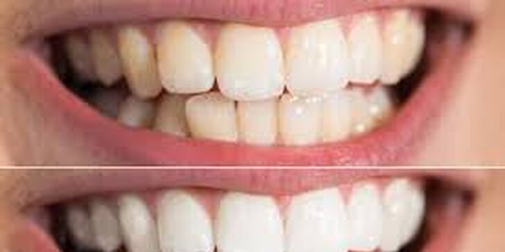 Bezperoxidové bělení zubů s aktivnímy částečkami uhlí