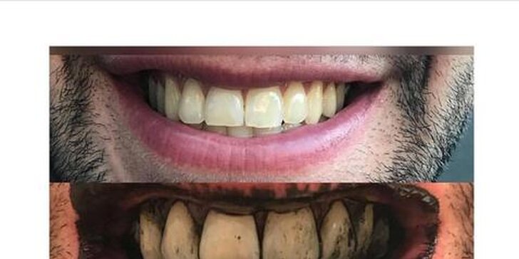 Bezperoxidové bělení zubů s aktivními částečkami uhlí