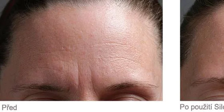 Aplikace Tria Botulotoxinu pro okamžité vyhlazení mimických vrásek