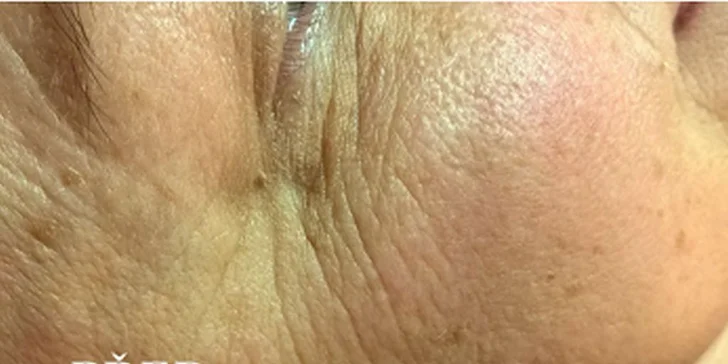 Krásná a mladistvá pleť: IPL Komplexní omlazení a manuální facelifting