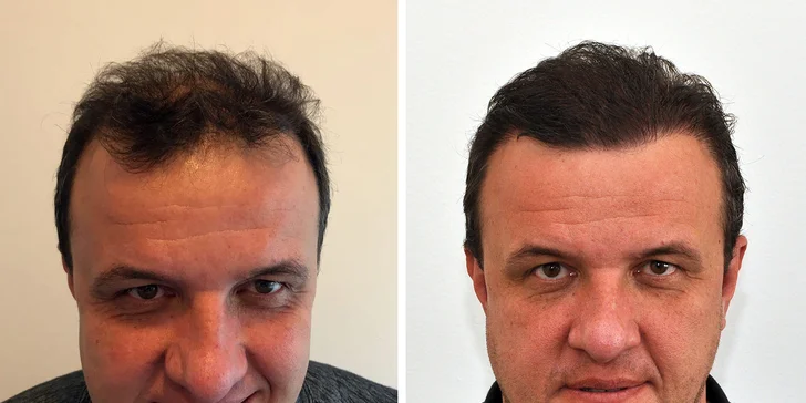 Záloha na bezbolestnou transplantaci vlasů v Istanbulu vč. cesty a hotelu