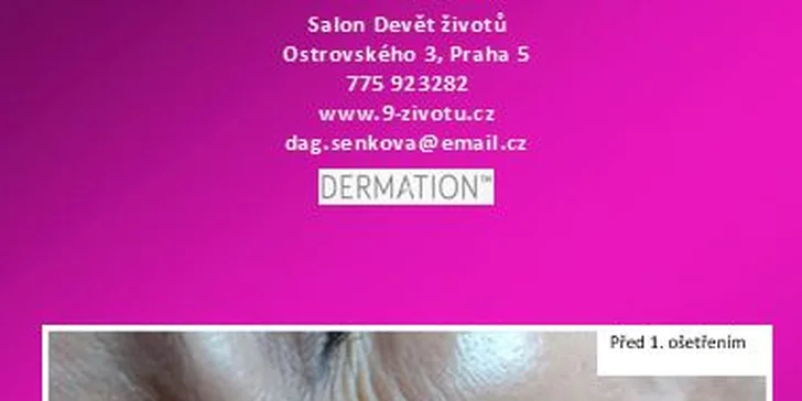 Neinvazivní omlazení pleti s okamžitým účinkem: Mezoterapie Dermation