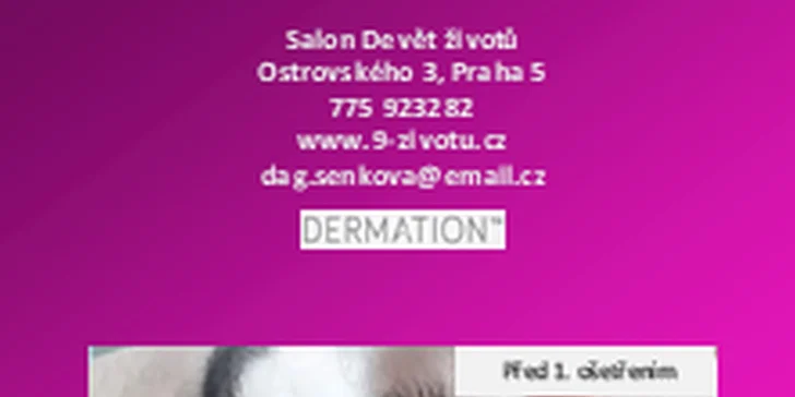Neinvazivní omlazení pleti s okamžitým účinkem: Mezoterapie Dermation