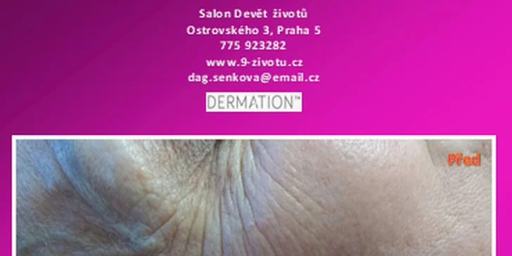 Neinvazivní omlazení pleti s okamžitým účinkem: Mezoterapie Dermation