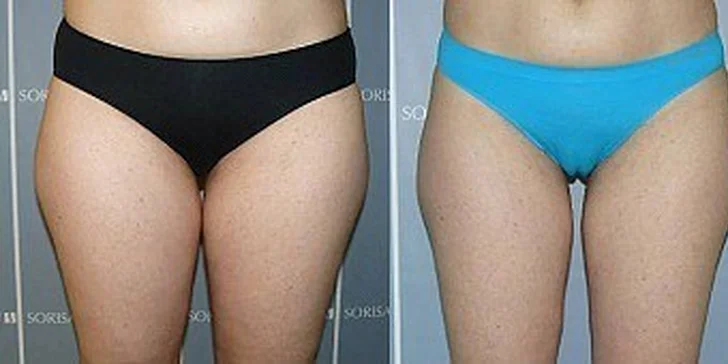 Léčba celulitidy a hubnutí řízené počítačem Bodyter Premium