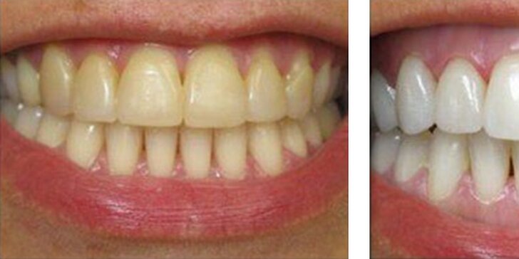 Zářivý úsměv snadno a šetrně: Neperoxidové bělení zubů s remineralizací skloviny
