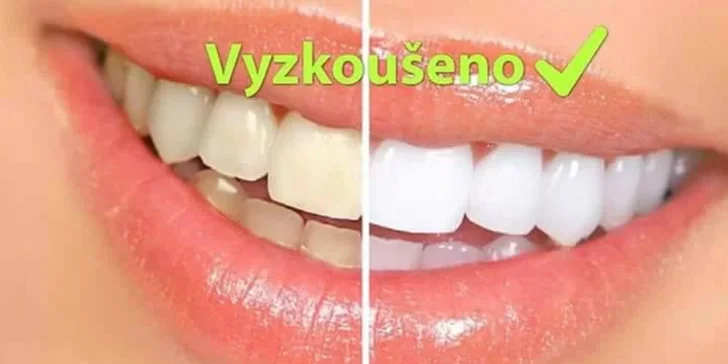 Zářivý úsměv šetrně: Neperoxidové bělení zubů