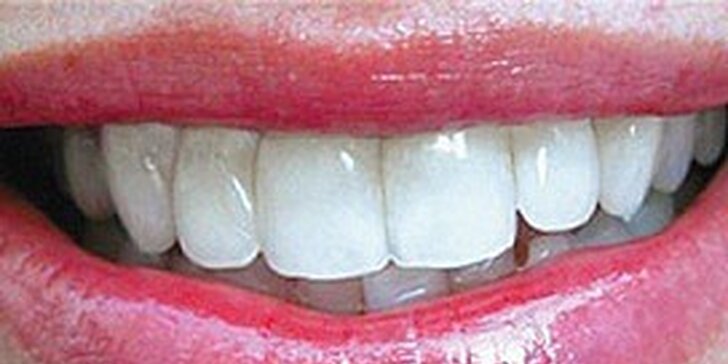 899 Kč za bělení zubů bez bolesti pro zářivý úsměv v hodnotě 3490 Kč