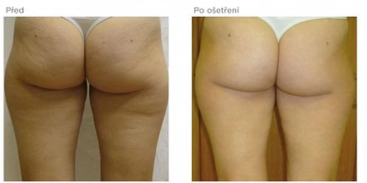 599 Kč za ultrazvukovou liposukci 3.generace v hodnotě 1200 Kč