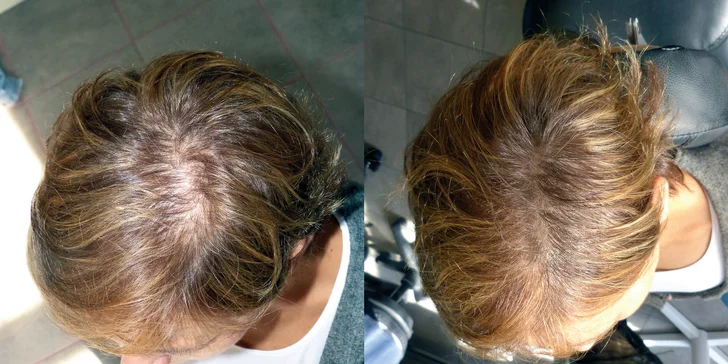 Připravte pleš o její lesk: tetování vlasů mikropigmentací