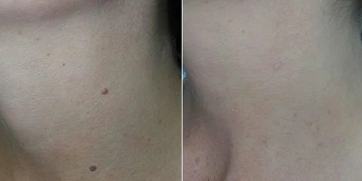 Bezbolestné laserové odstranění pih, znamének a bradavic