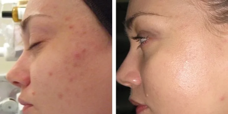 Balíčky pro zářivou pleť: ultrazvuk, mikrodermabraze nebo vitamínová péče