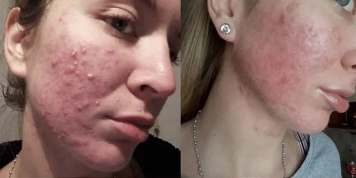 Pečujte o svou pleť: fotonová terapie pro lifting, odstranění akné a jizev