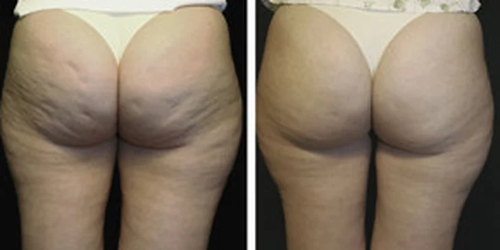 849 Kč za certifikovanou kryolipolýzu v hodnotě 8300 Kč. Ošetření 2-3 partií, výběr ze dvou přístrojů a 90 minut účinného odbourávání tuků se slevou 89 %.