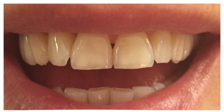 Zářivý úsměv šetrně: bělení zubů bez peroxidu a s remineralizací skloviny