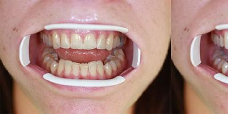 Zářivý úsměv šetrně: bělení zubů bez peroxidu a s remineralizací skloviny