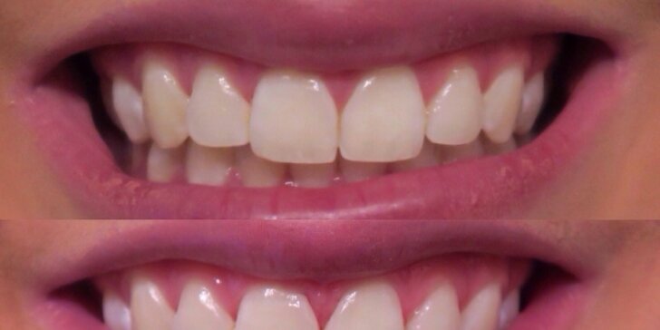 Zářivý úsměv snadno a šetrně: Neperoxidové bělení zubů s remineralizací skloviny