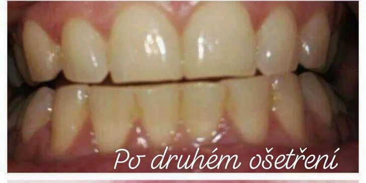Bezperoxidové bělení zubů gelem: zesvětlení až o 4 odstíny