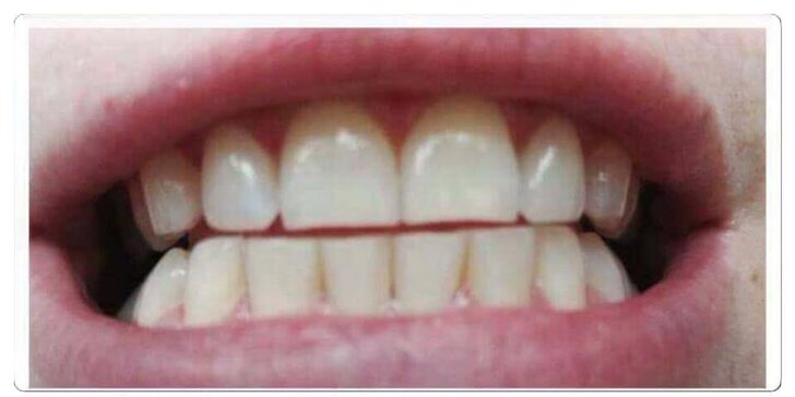 Bezperoxidové bělení zubů gelem: zesvětlení až o 4 odstíny