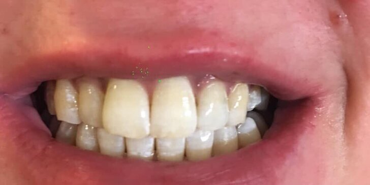 Bezperoxidové bělení zubů gelem: zesvětlení až o 4 odstíny