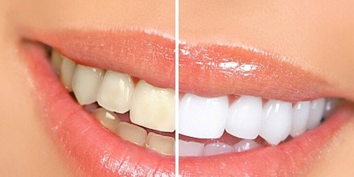 Neperoxidové bělení zubů metodou zvanou Smile Brilliant Teeth Whitening