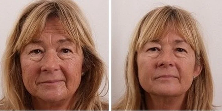 Facelifting s kyselinou hyaluronovou proti hlubokým vráskám