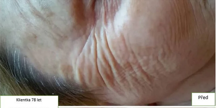 První ošetření IPL rejuvenace + Manuální facelifting.