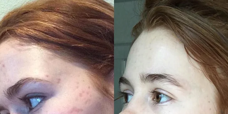 Výsledky po pravidelných návštěvách salonu při použití plazmových toků a face up ošetření.