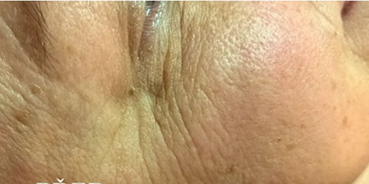 První ošetření IPL rejuvenace + Manuální facelifting.