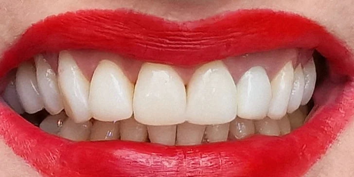 Philips Zoom WhiteSpeed dokáže za 45 minút vybieliť zuby až o osem odtieňov