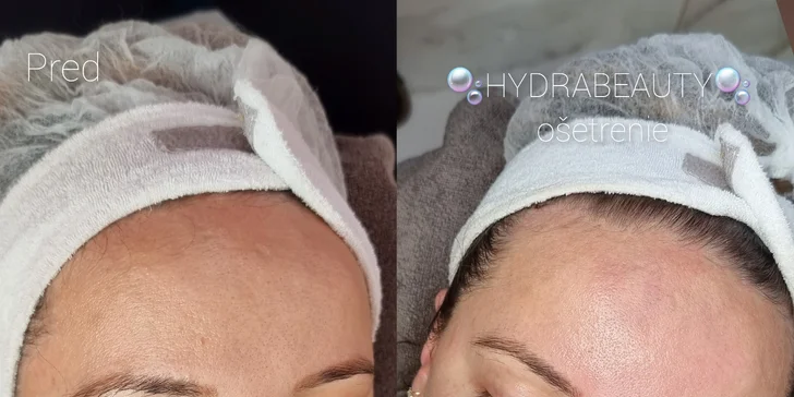 Hydrabeuty ošetrenie: pleť pred a po čistení.