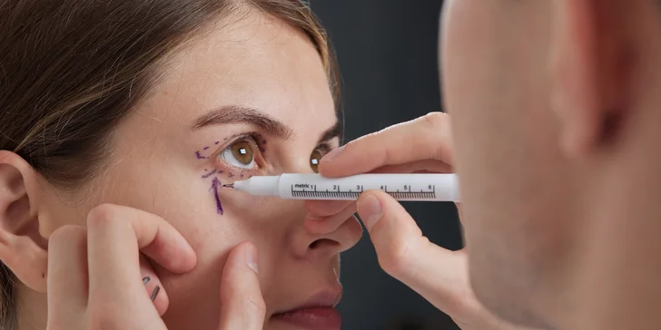 Cieľom blefaroplastiky je úprava previsu viečok. Môže sa vykonať na horných a rovnako i na dolných viečkach. 