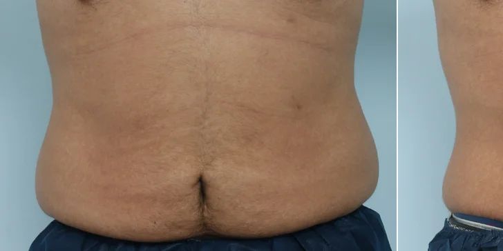 Výsledky u klienta po dvou ošetření kryolipolýzy foto v rozmezí cca 1,5 měsíce. Ošetřovaná oblast byla bříško a boky. 