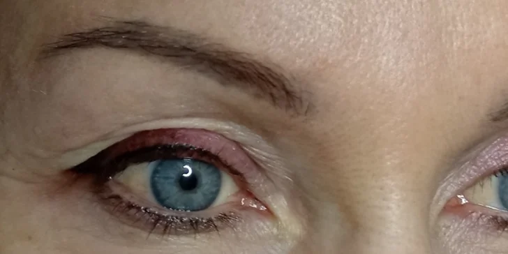 Ošetření je zároveň šetrné, hygienické a vhodné pro všechny typy pleti.