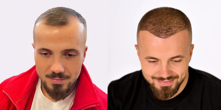 Pre a po - viac ako 8 mesiacov