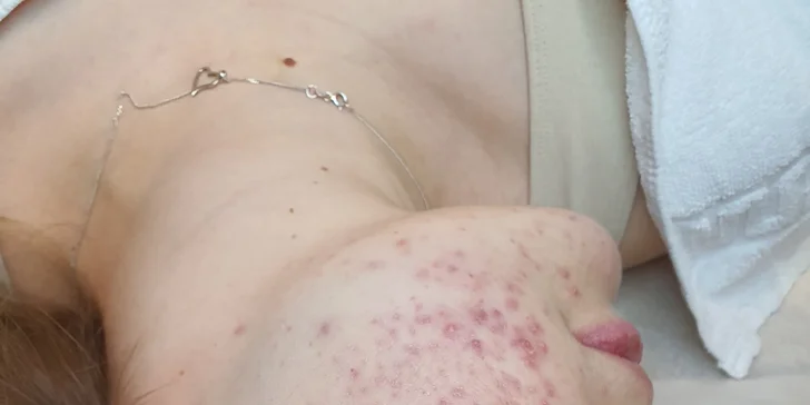 Ošetření zamezí množení kožních bakterií a pleť tak může konečně zářit zdravím.