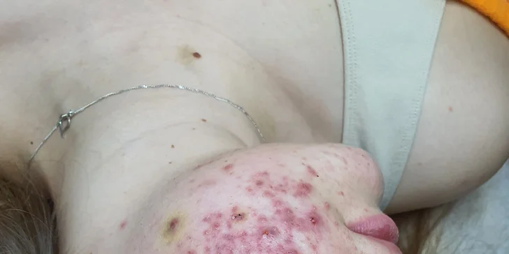  Lasocare® pracuje s neinvazivním biostimulačním laserem, který pleť vyčistí a přirozeně posílí ochrannou bariéru.