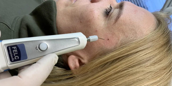 Plazmapero je inovatívny prístroj, ktorý dokáže pomôcť vaše pokožke mnohými spôsobmi