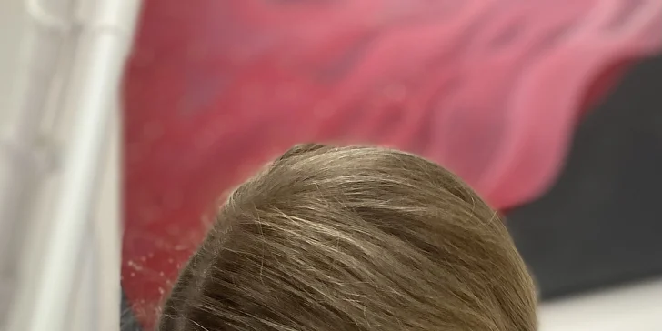 Odstranění laserem je rychlé a šetrné, bez bolesti a bez nutnosti rekonvalescence.