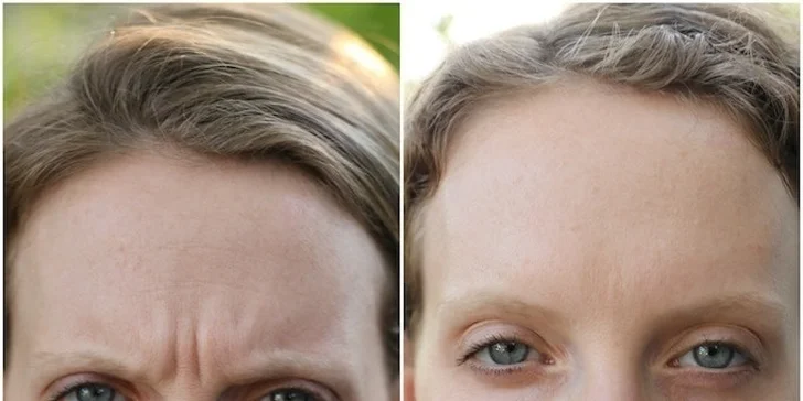 Prestaňte sa mračiť. Botox vám pomôže zahladiť aj vrásky medzi obočím.