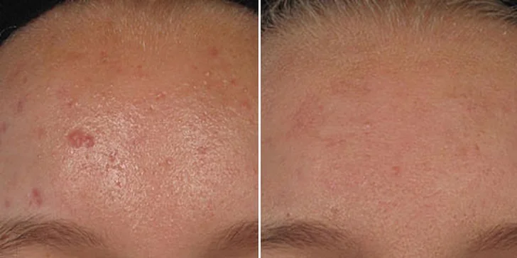 Výsledky po 2. ošetření akné - IPL fotorejuvenace