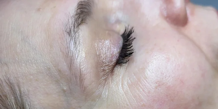 U mikrojehliček je v ceně zapracování séra s kyselinou hyaluronovou pomocí Dermapenu.