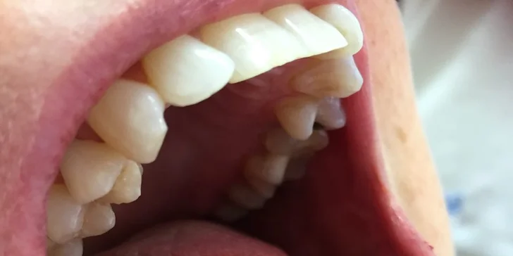 Výplň z nejnovějšího materiálu Filtek Ultimate zcela obnoví anatomický tvar zubů.