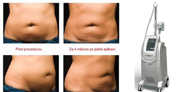Výsledky z ošetření po jedné aplikaci, pro maximálně efekt jsou doporučeny 2 ošetření.