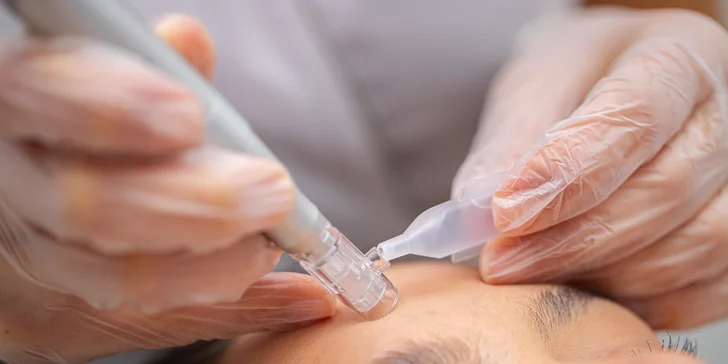 Microneedling (tiež mikroihličkovanie) je prevratná metóda, ktorou možno dosiahnuť vynikajúci efekt pre omladenie pokožky, vypnutie jemných vrások , zjednotenie tónu pleti, revitalizáciu a hydratáciu pleti, zmiernenie jaziev a strií.