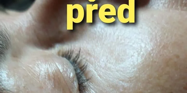 Nejžádanější variantou je vyhlazení vrásek a okamžitý efekt hyaluronové injekce, výrazné omlazení a hydratace. 
