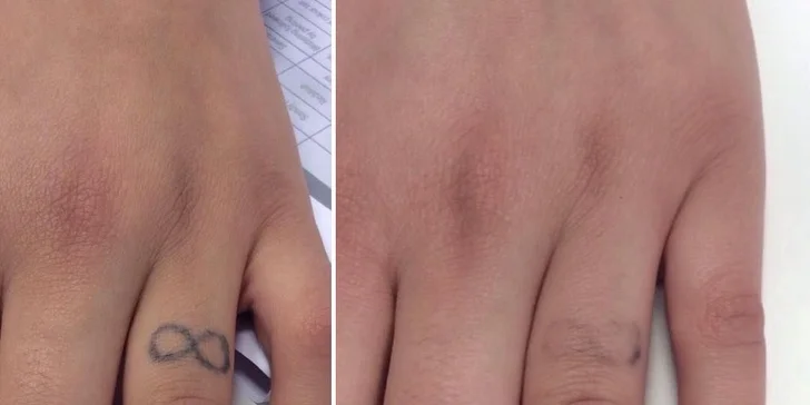Na místě vás čeká šetrná metoda jejich odstranění s využitím laseru Q-switched ND:YAG. 