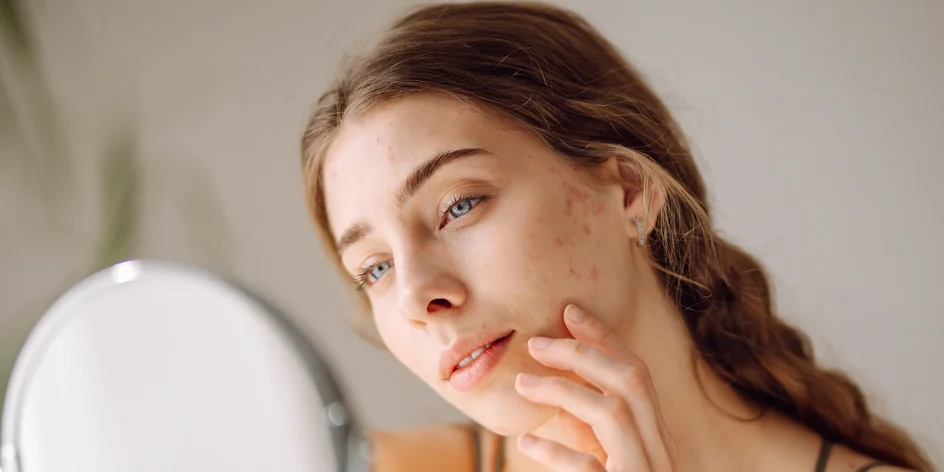 90minutové hojivé ošetření aknózní pleti