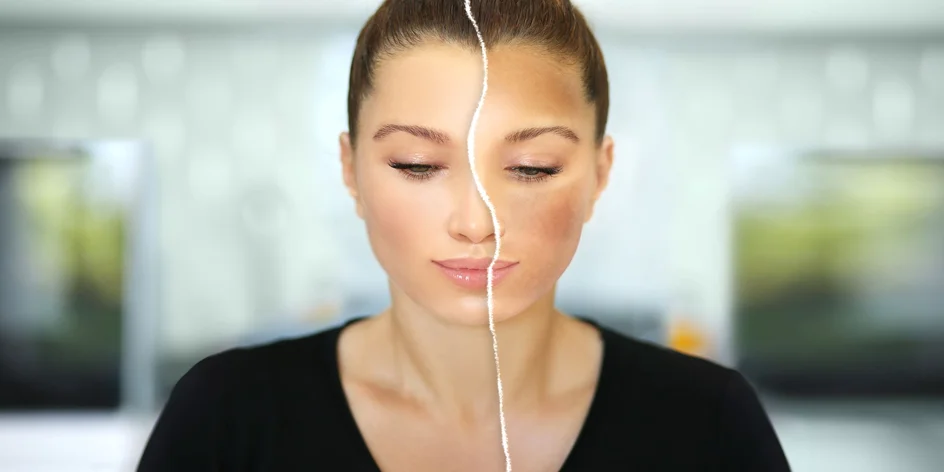 Trápia vás pigmentové škvrny? Poradíme vám, ako sa ich účinne zbaviť